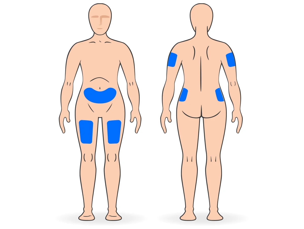 Diagram of subcutaneous injection sites on the body.
